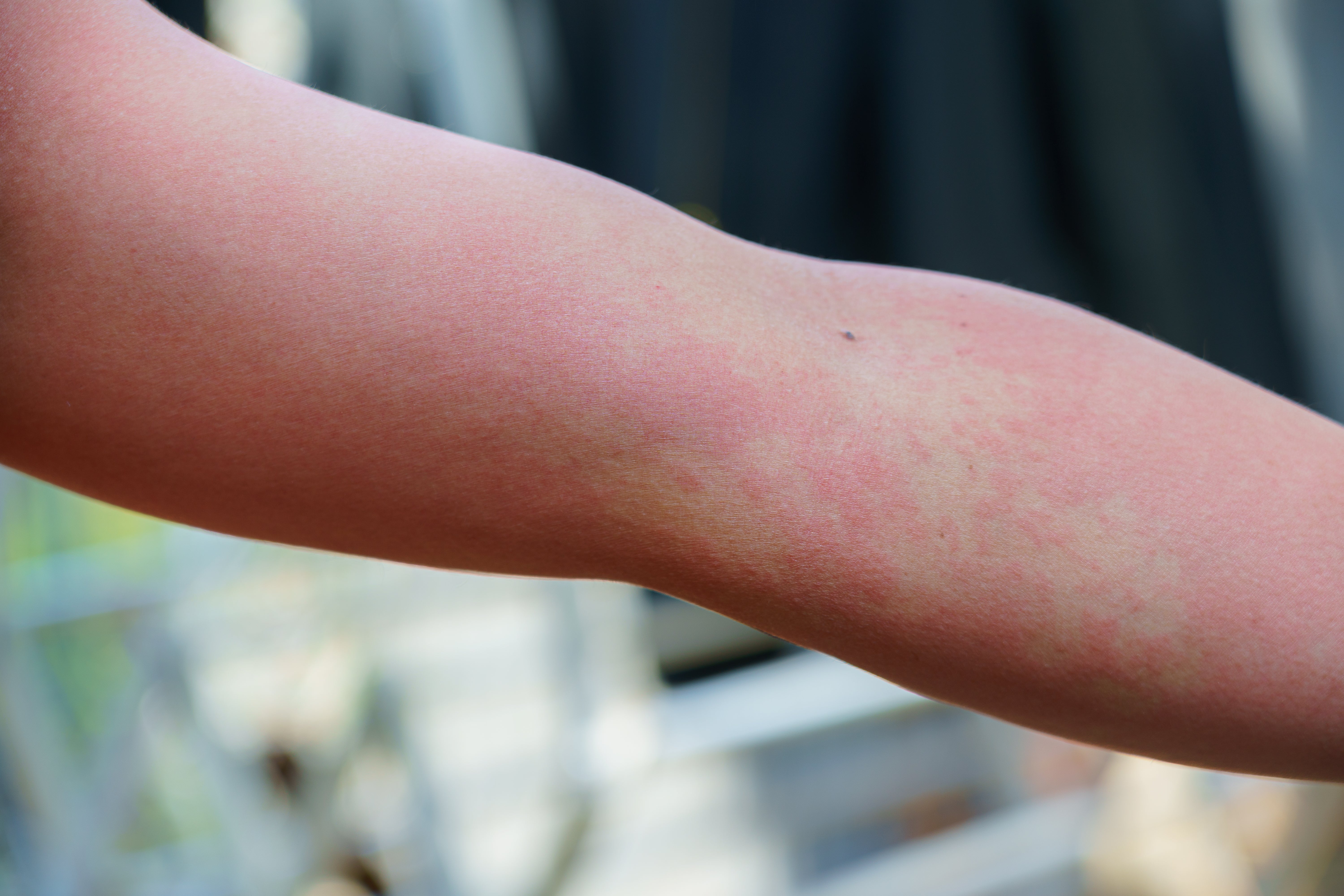 Ce sunt alergiile alimentare? Cauze, simptome și opțiuni de tratament